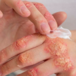 Fungal Infection Causes Symptoms